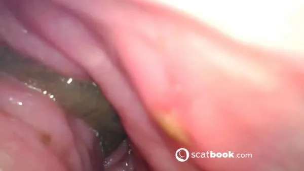 Endoscope In My Ass [FullHD 1080p / mp4 / 647 MB]